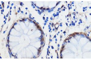 Immunohistochemistry of paraffin-embedded Human colon carcinoma using GCAT Polyclonal Antibody at dilution of 1:100 (40x lens).