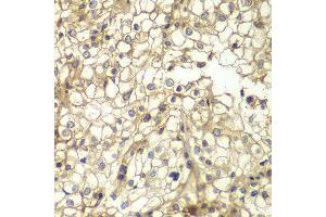 Immunohistochemistry of paraffin-embedded human kidney cancer using CD1D antibody at dilution of 1:200 (400x lens). (CD1d antibody)