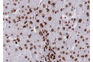 ABIN6267690 at 1/100 staining human Liver carcinoma tissue sections by IHC-P. (HDAC8 antibody  (pSer39))