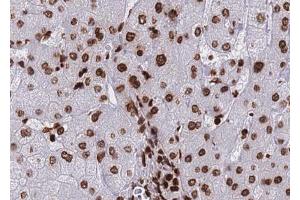 ABIN6267690 at 1/100 staining human Liver carcinoma tissue sections by IHC-P.