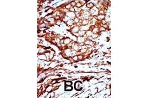 Formalin-fixed and paraffin-embedded human cancer tissue reacted with the primary antibody, which was peroxidase-conjugated to the secondary antibody, followed by AEC staining. (YWHAB antibody  (C-Term))