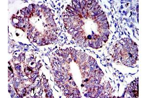 Immunohistochemical analysis of paraffin-embedded human rectum cancer tissues using AIF mouse mAb with DAB staining.