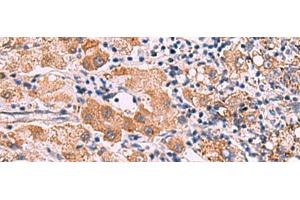 Immunohistochemistry of paraffin-embedded Human liver cancer tissue using IPPK Polyclonal Antibody at dilution of 1:30(x200) (IPPK antibody)