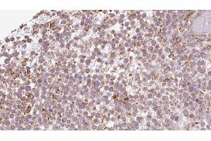 ABIN6273198 at 1/100 staining Human lymph cancer tissue by IHC-P. (ATP8A1 antibody  (Internal Region))