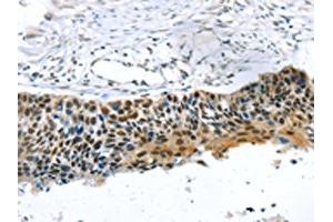 The image on the left is immunohistochemistry of paraffin-embedded Human esophagus cancer tissue using ABIN7192883(TRERF1 Antibody) at dilution 1/20, on the right is treated with synthetic peptide. (TRERF1 antibody)