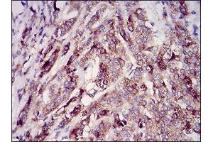 Immunohistochemical analysis of paraffin-embedded prostate cancer tissues using RAB27A mouse mAb with DAB staining. (RAB27A antibody  (AA 1-221))