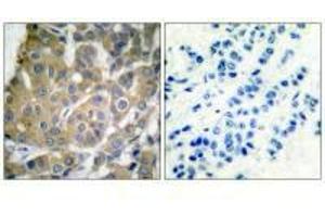 Immunohistochemical analysis of paraffin-embedded human breast carcinoma tissue using Cox2 antibody. (PTGS2 antibody)