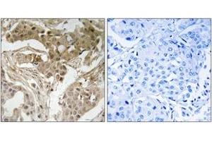 Immunohistochemistry analysis of paraffin-embedded human breast carcinoma, using FOS (Phospho-Thr232) Antibody. (c-FOS antibody  (pThr232))