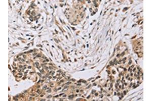The image on the left is immunohistochemistry of paraffin-embedded Human esophagus cancer tissue using ABIN7130575(PDLIM7 Antibody) at dilution 1/35, on the right is treated with fusion protein. (PDLIM7 antibody)