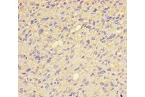 Immunohistochemistry of paraffin-embedded human glioma using ABIN7154027 at dilution of 1:100 (QPCT antibody  (AA 29-361))