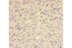 Immunohistochemistry of paraffin-embedded human glioma using ABIN7154027 at dilution of 1:100 (QPCT antibody  (AA 29-361))