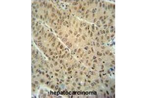 WDR32 antibody (N-term) immunohistochemistry analysis in formalin fixed and paraffin embedded human hepatocarcinoma followed by peroxidase conjugation of the secondary antibody and DAB staining. (DCAF10 antibody  (N-Term))