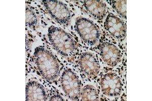Immunohistochemical analysis of Tyrosyl-tRNA Synthetase staining in human colon cancer formalin fixed paraffin embedded tissue section. (YARS antibody  (C-Term))