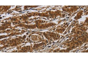 Immunohistochemistry of paraffin-embedded Human gasrtic cancer tissue using GATA5 Polyclonal Antibody at dilution 1:50