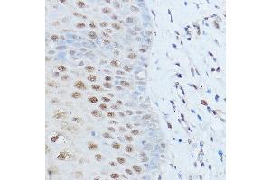 Immunohistochemistry of paraffin-embedded human esophageal cancer using SM antibody (ABIN6128718, ABIN6148113, ABIN6148114 and ABIN6215679) at dilution of 1:100 (40x lens).