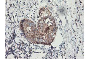 Immunohistochemical staining of paraffin-embedded Adenocarcinoma of Human breast tissue using anti-MTFMT mouse monoclonal antibody. (MTFMT antibody  (AA 175-389))