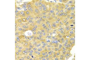 Immunohistochemistry of paraffin-embedded human liver cancer using PA2G4 Antibody (ABIN5973112) at dilution of 1/100 (40x lens). (PA2G4 antibody)