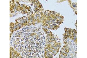 Immunohistochemistry of paraffin-embedded Human endometrial cancer using DLD Polyclonal Antibody at dilution of 1:100 (40x lens).