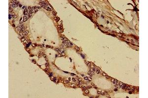 Immunohistochemistry of paraffin-embedded human pancreatic cancer using ABIN7148353 at dilution of 1:100 (C1R antibody  (AA 65-192))