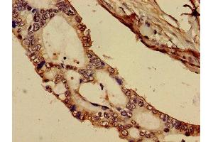 Immunohistochemistry of paraffin-embedded human pancreatic cancer using ABIN7148353 at dilution of 1:100