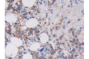 Detection of MHCC in Human Skin cancer Tissue using Polyclonal Antibody to Major Histocompatibility Complex Class I C (MHCC) (MHCC (AA 48-305) antibody)