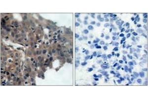 Immunohistochemistry analysis of paraffin-embedded human breast carcinoma, using p21 Cip1 (Phospho-Thr145) Antibody.
