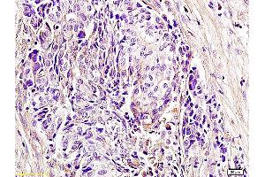 Formalin-fixed and paraffin embedded human laryngocarcinoma labeled with Anti CD336 NKp44 NCR2 Polyclonal Antibody, unconjugated (ABIN740010) at 1:400 followed by incubation with conjugated secondary antibody and DAB staining. (NKp44/NCR2 antibody  (AA 201-276))
