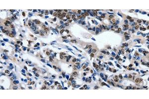 Immunohistochemistry of paraffin-embedded Human gasrtic cancer tissue using CD203c Polyclonal Antibody at dilution 1:80 (ENPP3 antibody)