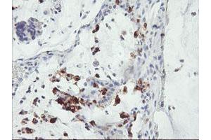 Immunohistochemical staining of paraffin-embedded Adenocarcinoma of Human colon tissue using anti-SDS mouse monoclonal antibody. (serine Dehydratase antibody)