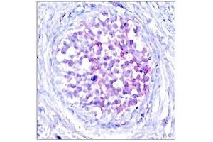 Immunohistochemical analysis of paraffin-embedded human breast carcinoma tissue using Raf1(Phospho-Ser259) Antibody. (RAF1 antibody  (pSer259))