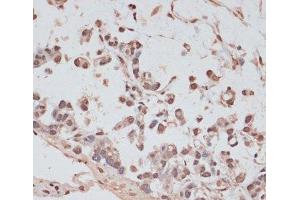 Immunohistochemistry of paraffin-embedded Human gastric cancer using PRPF31 Polyclonal Antibody at dilution of 1:100 (40x lens).