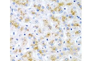 Immunohistochemistry of paraffin-embedded Human liver damage using WNT2 Polyclonal Antibody at dilution of 1:200 (40x lens). (WNT2 antibody)