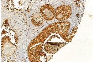 ABIN6264959 and ABIN6272887 at 1/100 staining Human breast cancer by IHC-P. (EXOC2 antibody  (N-Term))