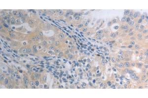 Immunohistochemistry of paraffin-embedded Human ovarian cancer tissue using SHH Polyclonal Antibody at dilution 1:40 (Sonic Hedgehog antibody)