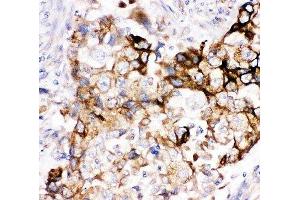 IHC-P: Heme Oxygenase 2 antibody testing of human lung cancer tissue (HMOX2 antibody  (AA 2-316))