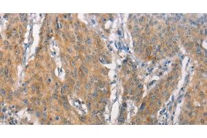 Immunohistochemistry of paraffin-embedded Human gastric cancer tissue using CEACAM6 Polyclonal Antibody at dilution 1:50 (CEACAM6 antibody)