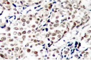 Immunohistochemistry (IHC) analysis of p-Chk1 (pSer345) pAb in paraffin-embedded human breast carcinoma tissue (CHEK1 antibody  (pSer345))