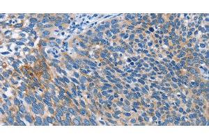 Immunohistochemistry of paraffin-embedded Human cervical cancer tissue using AHR Polyclonal Antibody at dilution 1:50 (Aryl Hydrocarbon Receptor antibody)