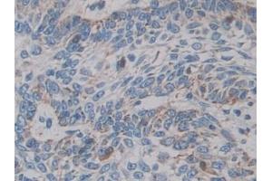 Detection of CYP21A2 in Human Skin cancer Tissue using Polyclonal Antibody to Cytochrome P450 Family 21 Subfamily A Member 2 (CYP21A2) (CYP21A2 antibody  (AA 106-389))