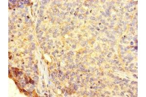 Immunohistochemistry of paraffin-embedded human ovarian cancer using ABIN7154641 at dilution of 1:100 (RHEBL1 antibody  (AA 1-180))
