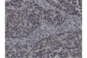 Immunohistochemical staining of paraffin-embedded Carcinoma of Human kidney tissue using anti-BTN1A1 mouse monoclonal antibody.