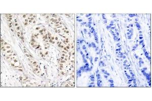 Immunohistochemical analysis of paraffin-embedded human breast carcinoma tissue, using BRCA1 (phospho-Ser1524) antibody (E011117). (BRCA1 antibody  (pSer1524))