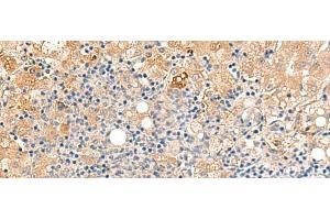 Immunohistochemistry of paraffin-embedded Human liver cancer tissue using MEST Polyclonal Antibody at dilution of 1:50(x200) (MEST antibody)