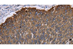Immunohistochemistry of paraffin-embedded Human lung cancer using KRT31 Polyclonal Antibody at dilution of 1:30 (Keratin 31 antibody)