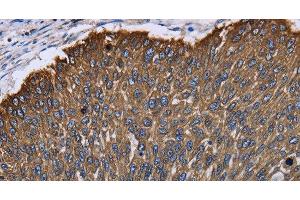 Immunohistochemistry of paraffin-embedded Human lung cancer using KRT31 Polyclonal Antibody at dilution of 1:30