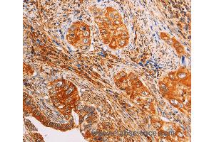 Immunohistochemistry of Human cervical cancer using SLC25A4 Polyclonal Antibody at dilution of 1:40 (SLC25A4 antibody)