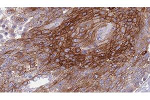 ABIN6277297 at 1/100 staining Human urothelial cancer tissue by IHC-P. (Betacellulin antibody  (N-Term))