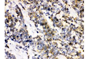 Anti- Ataxin 3 Picoband antibody, IHC(P) IHC(P): Human Lung Cancer Tissue (Ataxin 3 antibody  (C-Term))