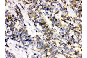 Anti- Ataxin 3 Picoband antibody, IHC(P) IHC(P): Human Lung Cancer Tissue