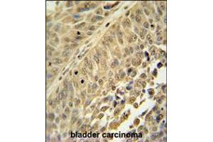 HNRNPC antibody immunohistochemistry analysis in formalin fixed and paraffin embedded human bladder carcinoma followed by peroxidase conjugation of the secondary antibody and DAB staining. (HNRNPC antibody  (C-Term))